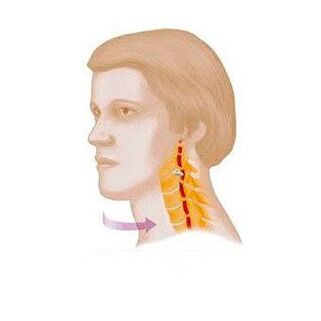 Wirbelsyndrom mit zervikaler Osteochondrose