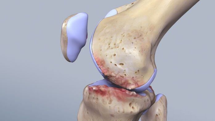 Die Struktur des Kniegelenks ist von der Pathologie betroffen