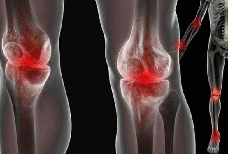 Schmerzen in den Gelenken der Arme und Beine, die durch verschiedene Krankheiten verursacht werden