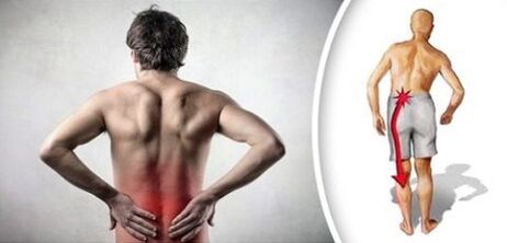 Schmerzsyndrom mit lumbaler Osteochondose strahlt auf die Beine