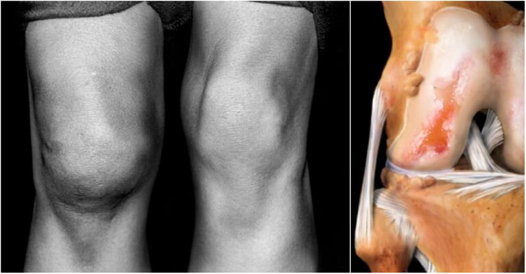 Arthrose des Kniegelenks und Dutzend