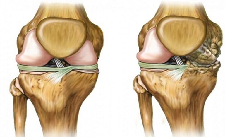 Gesund und beeindruckt vom Arthrosis -Gelenk