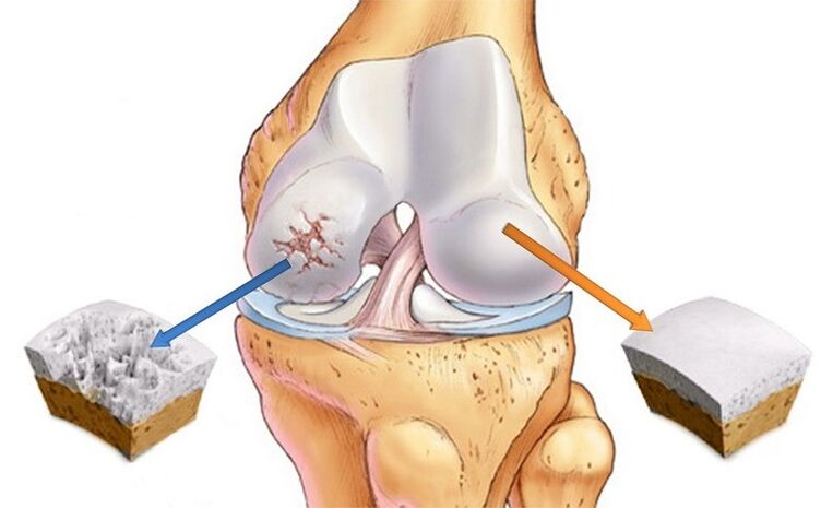Normaler Knorpel und von Arthritis getroffen