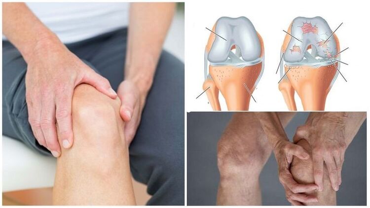 Symptom für Knieschmerzen der Arthrose des Kniegelenks