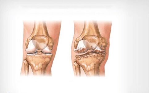 Arthrose des Kniegelenks