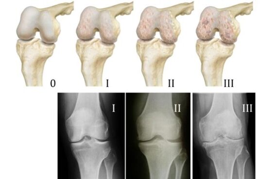Methoden zur Diagnose von Knie-Arthrose